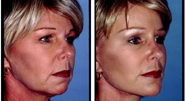 Facelift Before and After Pictures Boca Raton, FL