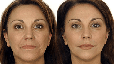 Dermal Fillers and Injectables in Boca Raton, FL