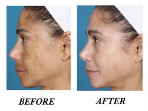 DMMD Before and After Pictures Boca Raton, FL