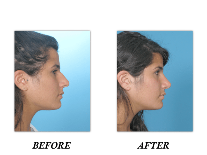 Rhinoplasty Before and After Pictures Boca Raton, FL