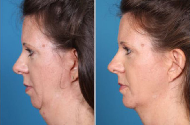 Chin Implant Before and After Pictures Boca Raton, FL
